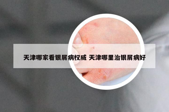 天津哪家看银屑病权威 天津哪里治银屑病好