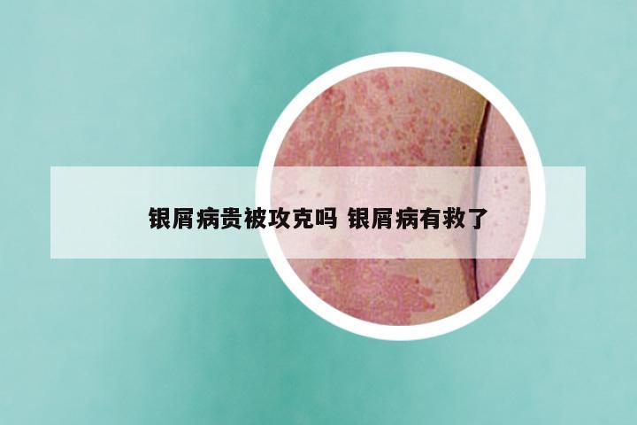 银屑病贵被攻克吗 银屑病有救了