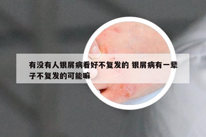 有没有人银屑病看好不复发的 银屑病有一辈子不复发的可能嘛