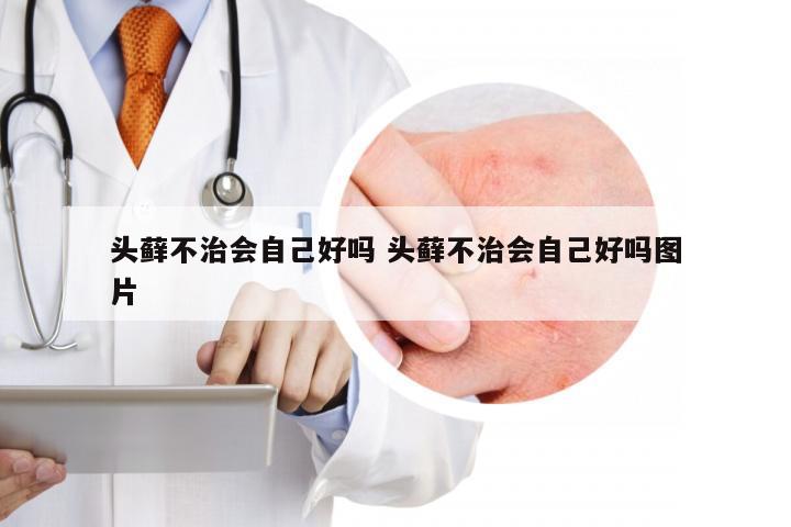 头藓不治会自己好吗 头藓不治会自己好吗图片