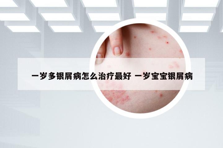 一岁多银屑病怎么治疗最好 一岁宝宝银屑病