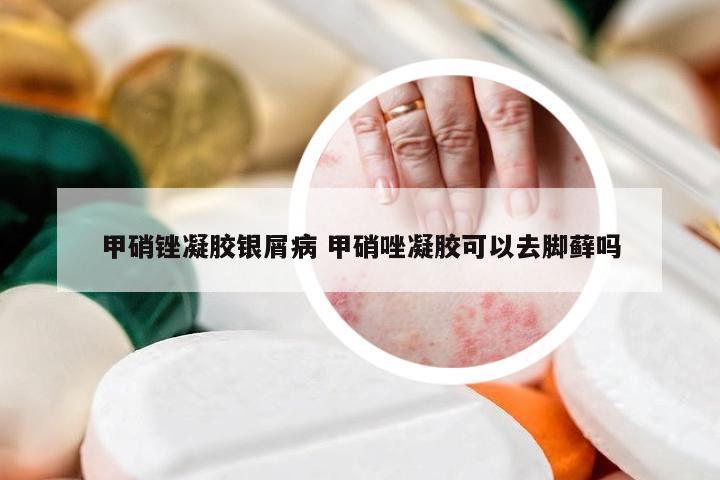 甲硝锉凝胶银屑病 甲硝唑凝胶可以去脚藓吗