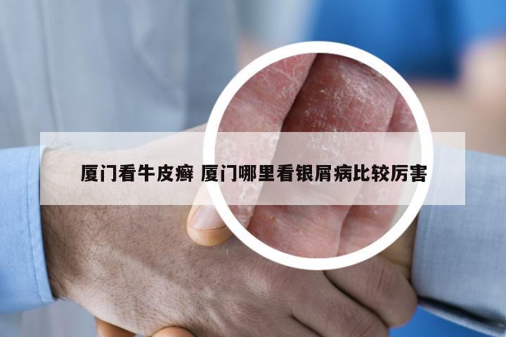 厦门看牛皮癣 厦门哪里看银屑病比较厉害