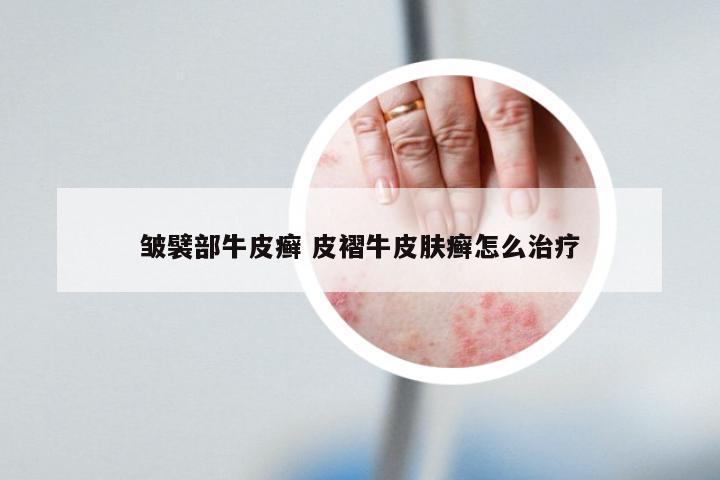 皱襞部牛皮癣 皮褶牛皮肤癣怎么治疗