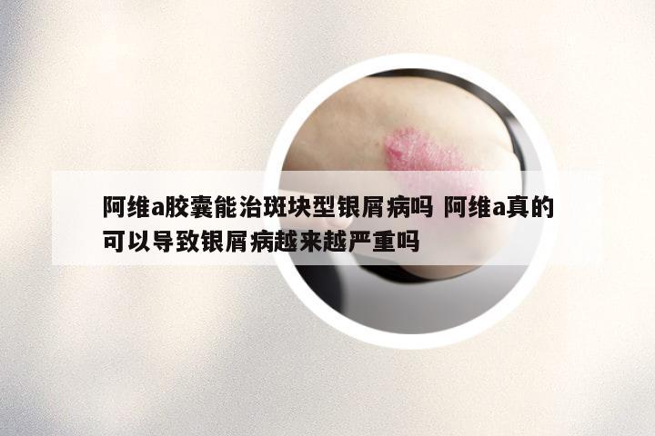 阿维a胶囊能治斑块型银屑病吗 阿维a真的可以导致银屑病越来越严重吗