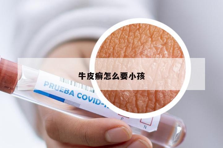 牛皮癣怎么要小孩