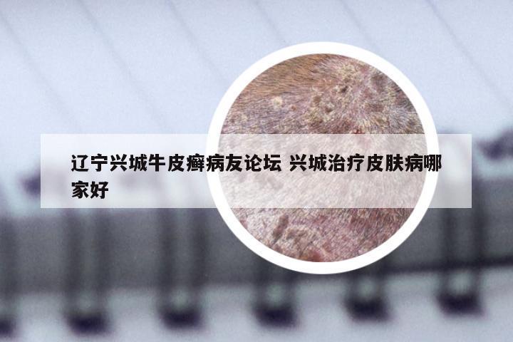 辽宁兴城牛皮癣病友论坛 兴城治疗皮肤病哪家好