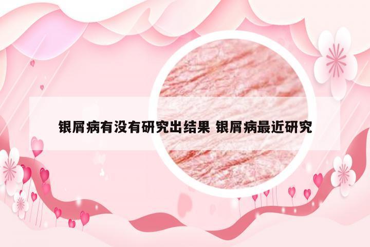 银屑病有没有研究出结果 银屑病最近研究