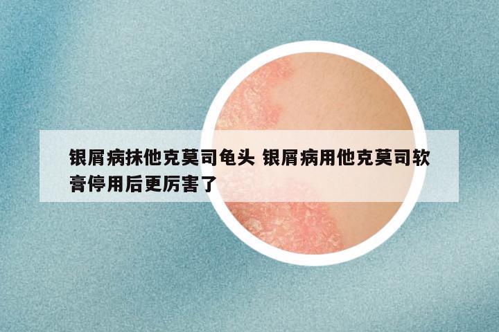 银屑病抹他克莫司龟头 银屑病用他克莫司软膏停用后更厉害了