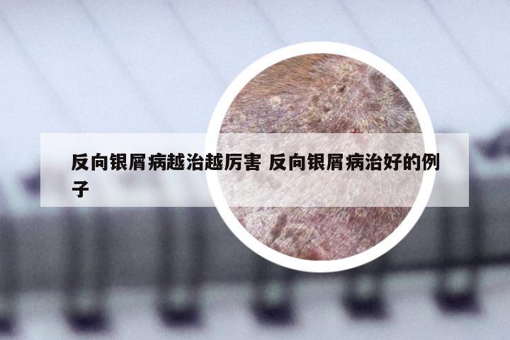 反向银屑病越治越厉害 反向银屑病治好的例子
