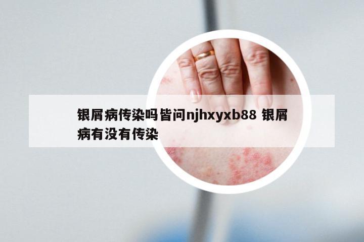 银屑病传染吗皆问njhxyxb88 银屑病有没有传染