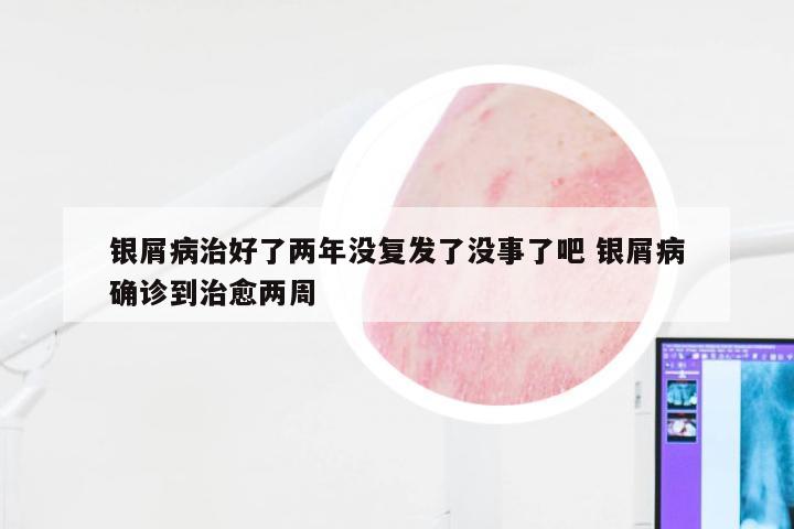 银屑病治好了两年没复发了没事了吧 银屑病确诊到治愈两周