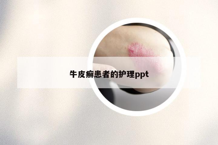 牛皮癣患者的护理ppt
