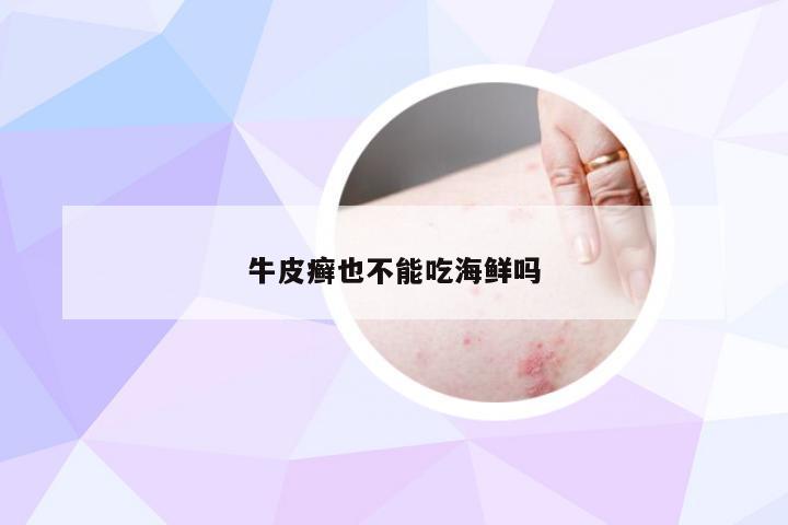 牛皮癣也不能吃海鲜吗