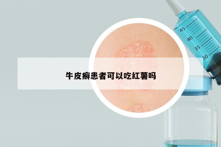 牛皮癣患者可以吃红薯吗