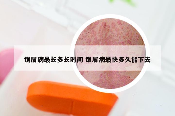 银屑病最长多长时间 银屑病最快多久能下去