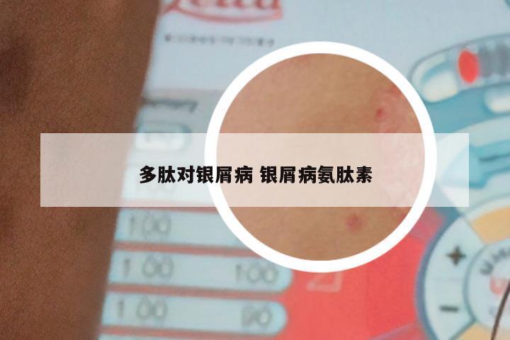 多肽对银屑病 银屑病氨肽素