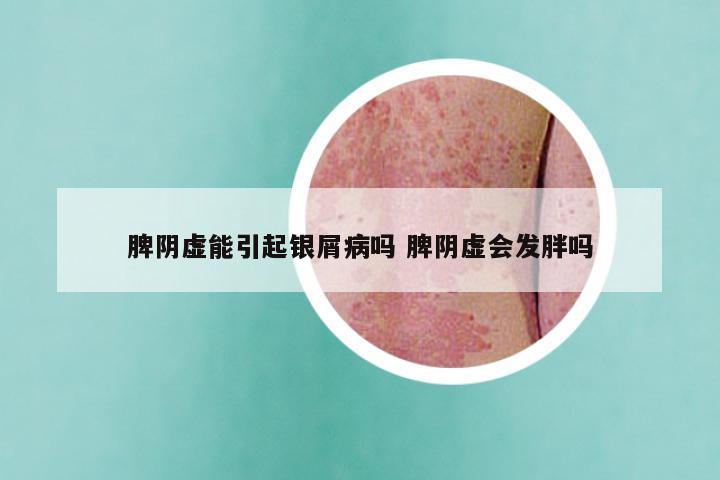 脾阴虚能引起银屑病吗 脾阴虚会发胖吗
