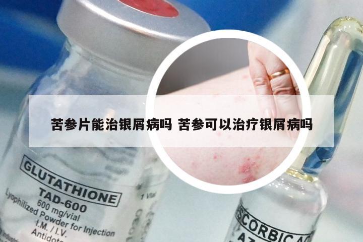苦参片能治银屑病吗 苦参可以治疗银屑病吗