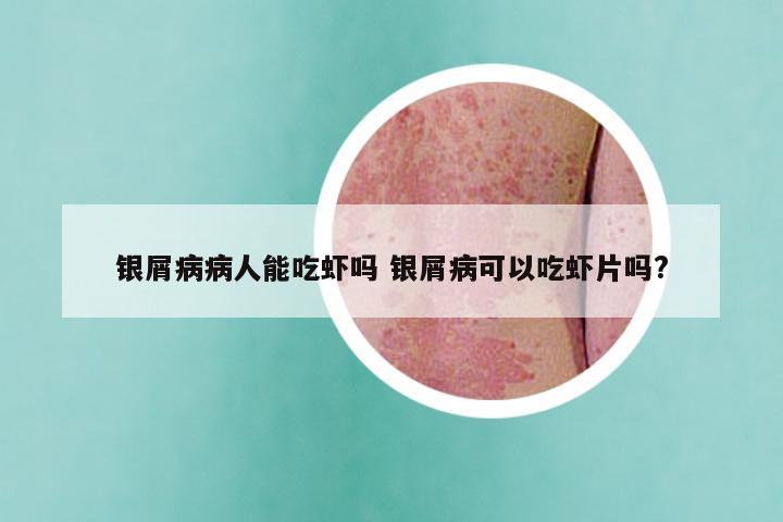 银屑病病人能吃虾吗 银屑病可以吃虾片吗?