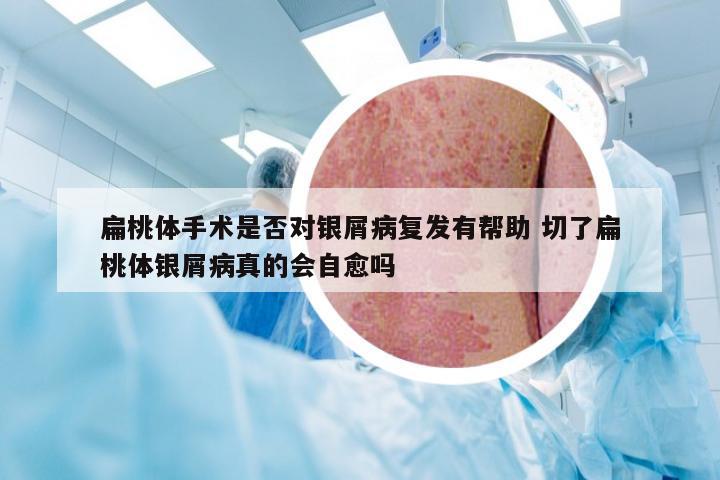 扁桃体手术是否对银屑病复发有帮助 切了扁桃体银屑病真的会自愈吗