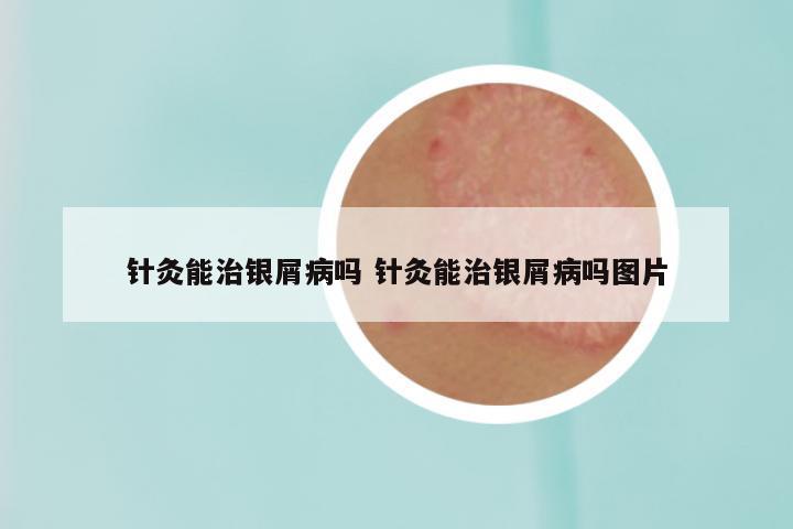针灸能治银屑病吗 针灸能治银屑病吗图片