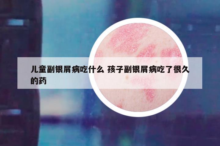 儿童副银屑病吃什么 孩子副银屑病吃了很久的药