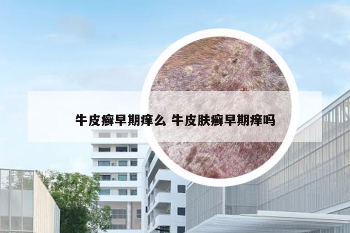 牛皮癣早期痒么 牛皮肤癣早期痒吗