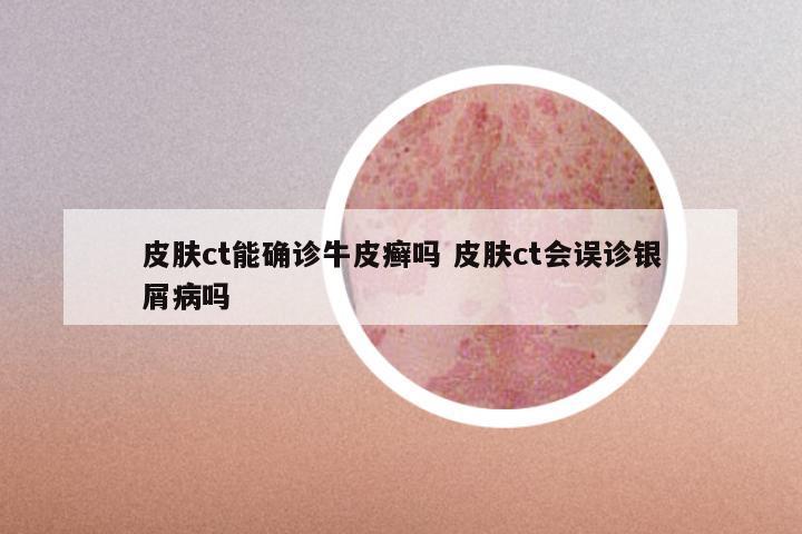 皮肤ct能确诊牛皮癣吗 皮肤ct会误诊银屑病吗