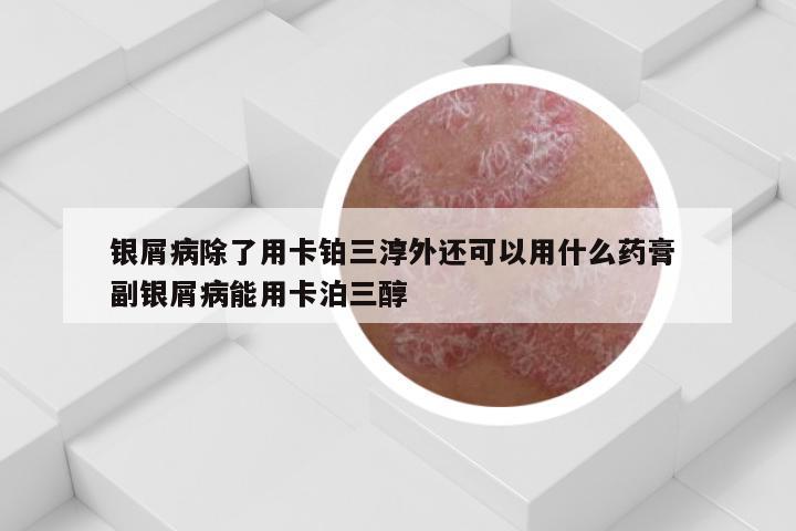 银屑病除了用卡铂三淳外还可以用什么药膏 副银屑病能用卡泊三醇