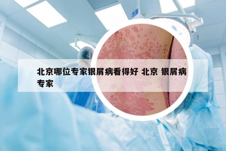 北京哪位专家银屑病看得好 北京 银屑病 专家