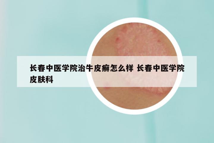 长春中医学院治牛皮癣怎么样 长春中医学院皮肤科