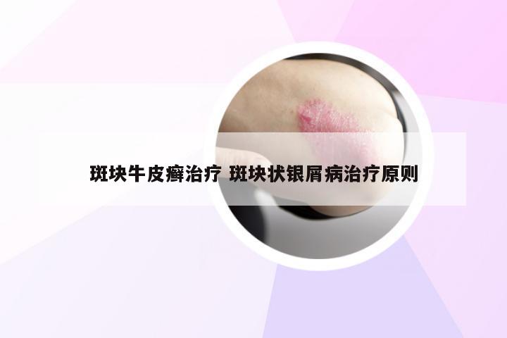 斑块牛皮癣治疗 斑块状银屑病治疗原则