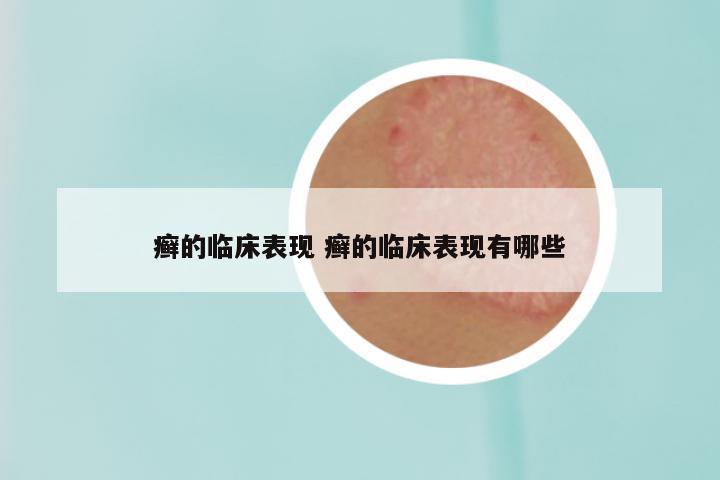 癣的临床表现 癣的临床表现有哪些