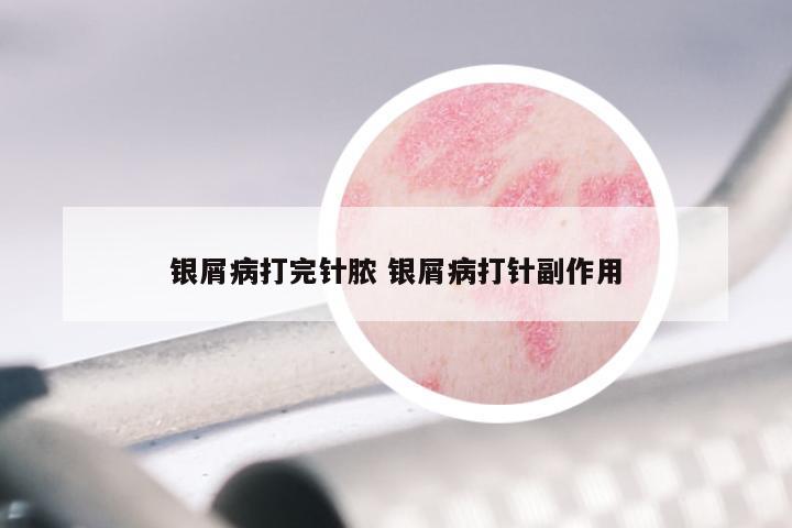 银屑病打完针脓 银屑病打针副作用