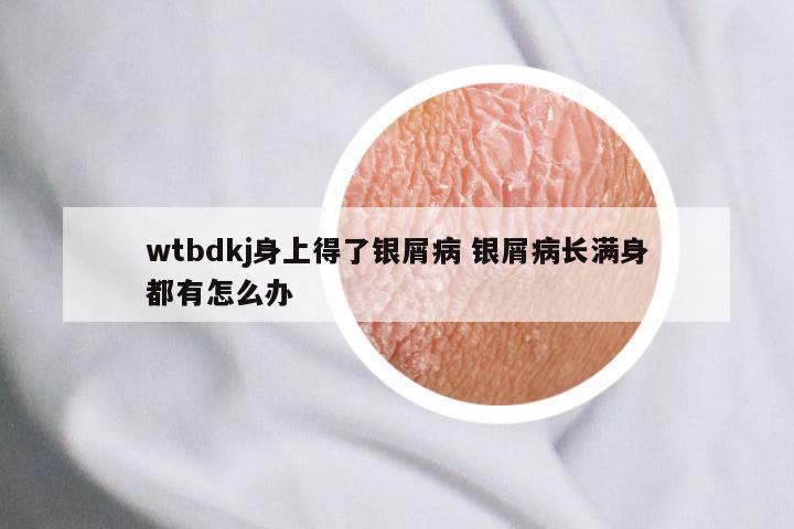 wtbdkj身上得了银屑病 银屑病长满身都有怎么办