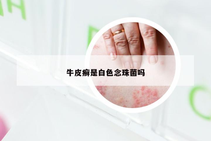 牛皮癣是白色念珠菌吗