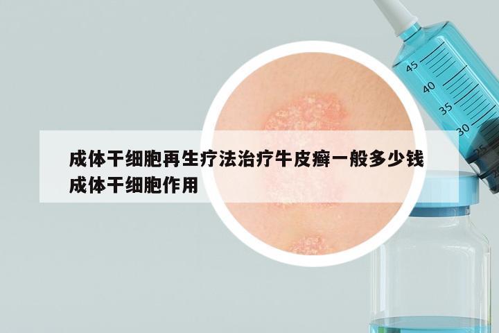 成体干细胞再生疗法治疗牛皮癣一般多少钱 成体干细胞作用