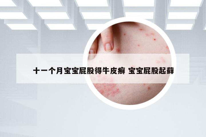 十一个月宝宝屁股得牛皮癣 宝宝屁股起藓