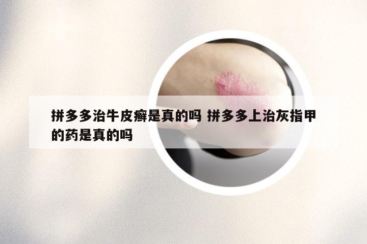 拼多多治牛皮癣是真的吗 拼多多上治灰指甲的药是真的吗