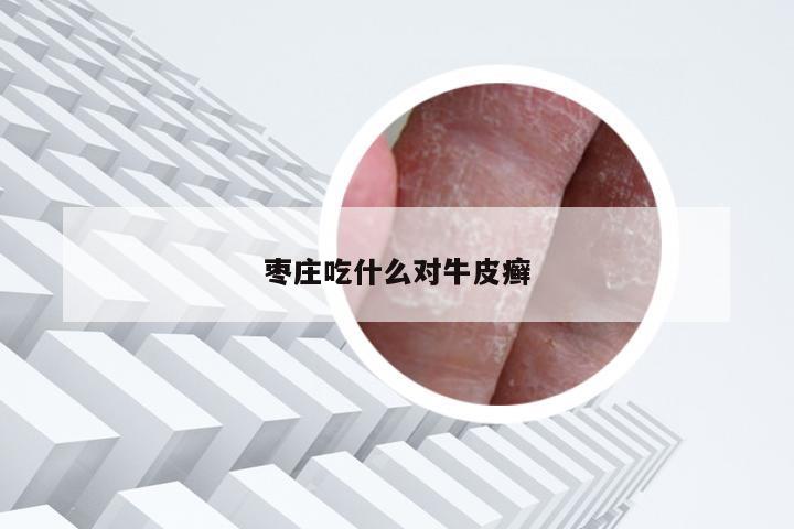 枣庄吃什么对牛皮癣