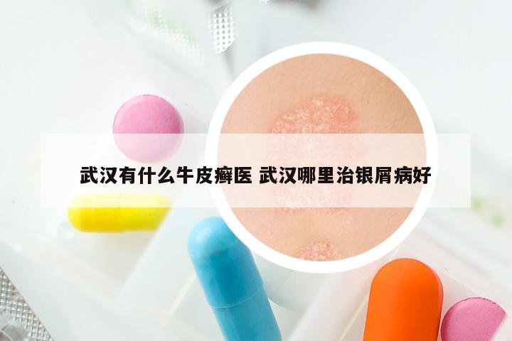 武汉有什么牛皮癣医 武汉哪里治银屑病好