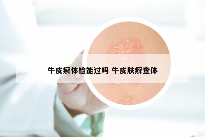 牛皮癣体检能过吗 牛皮肤癣查体