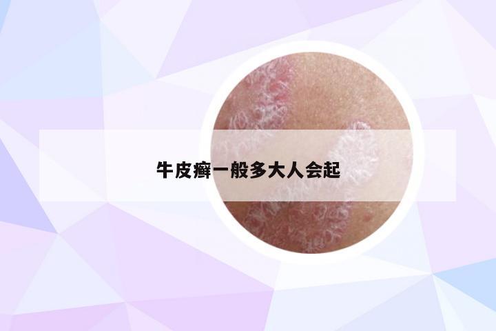 牛皮癣一般多大人会起