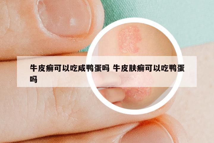 牛皮癣可以吃咸鸭蛋吗 牛皮肤癣可以吃鸭蛋吗
