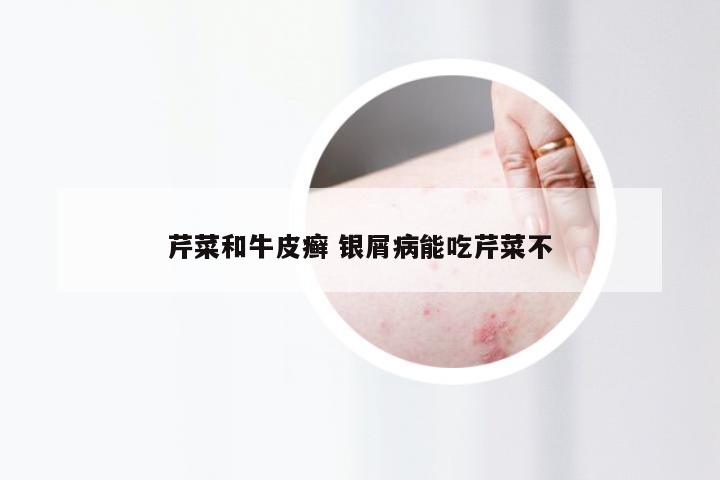 芹菜和牛皮癣 银屑病能吃芹菜不