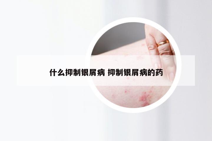 什么抑制银屑病 抑制银屑病的药