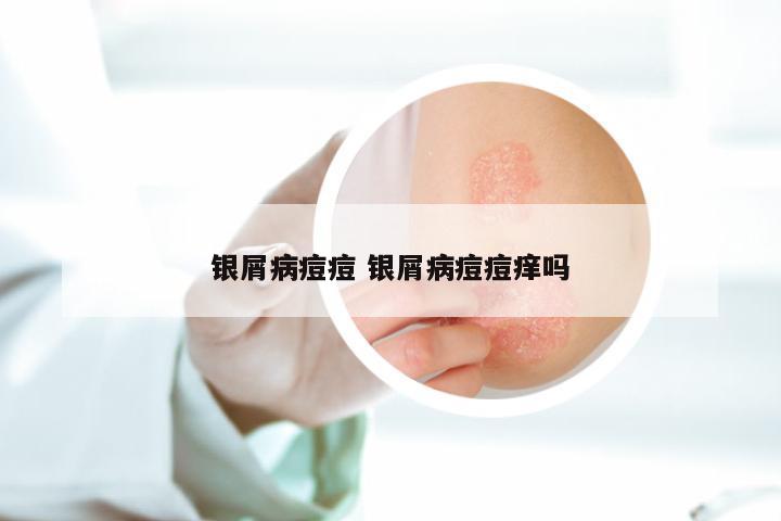 银屑病痘痘 银屑病痘痘痒吗