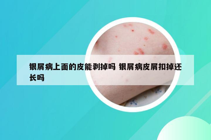 银屑病上面的皮能剥掉吗 银屑病皮屑扣掉还长吗