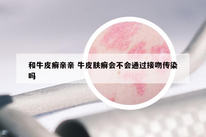 和牛皮癣亲亲 牛皮肤癣会不会通过接吻传染吗